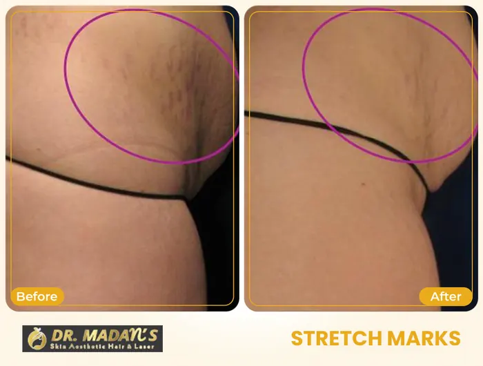 Stretch marks before and after result 12 at Dr Madan Aesthetics